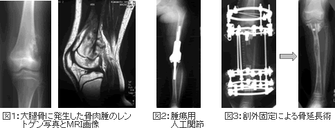 図１：大腿骨に発生した骨肉腫のレントゲン写真とMRI画像　図２：腫瘍用人工関節 図３：創外固定による骨延長術