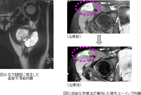 図４：左大腿部に発生した血管平滑筋肉腫　図５：術前化学療法が奏効した骨外ユーイング肉腫