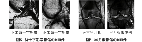 図5　前十字靱帯損傷のMRI像 図6　半月板損傷のMRI像