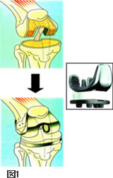 図1　人工膝関節置換術
